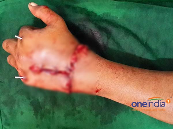 Chennai doctors fix AP woman's chopped off hand