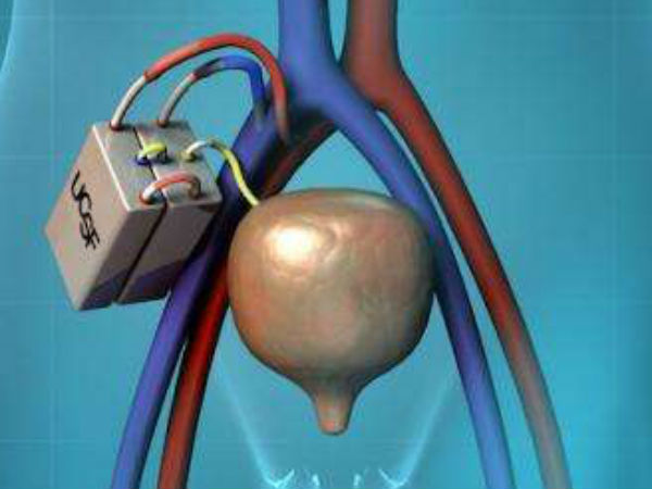 மாற்று சிறுநீரகம்...