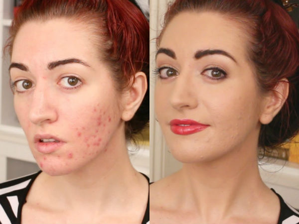 பர்பெக்ட் ஆக்னே கவரிங் மேக்கப்: