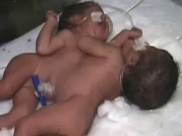 Woman gives birth to conjoined twins in Agra Woman gives birth to conjoined twins in Agra