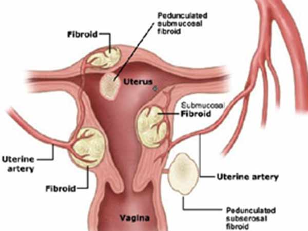 அகற்றம்...