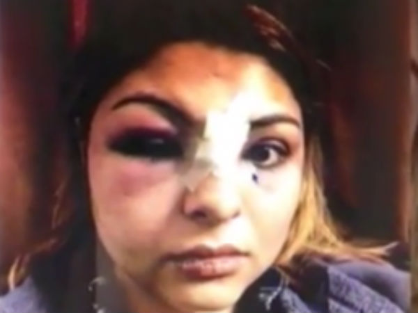 Delhi model’s sister releases pics, says husband beat her mercilessly Delhi model’s sister releases pics, says husband beat her mercilessly