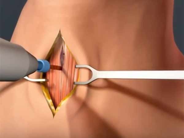 தொண்டையில் அறுவை சிகிச்சை