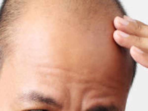 வழுக்கைத் தலையில் தங்கம்