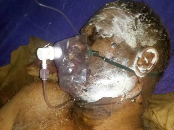  ஸ்டான்லி மருத்துவமனையில் 12 பேர் 