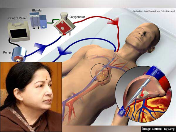 எக்மோ சிகிச்சை