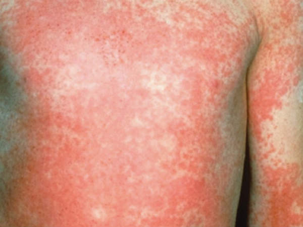 ஸ்கார்லெட் நோய் 