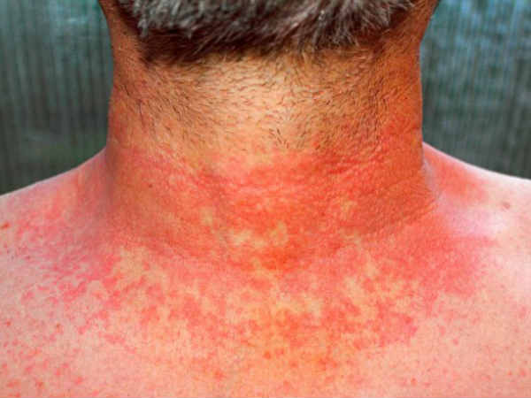 அறிகுறிகள் 