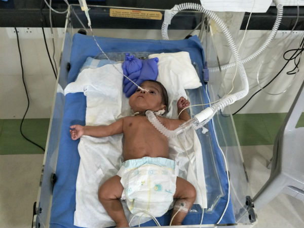 After Losing One Of Their Twins, They’re Struggling To Save The Other After Losing One Of Their Twins, They’re Struggling To Save The Other