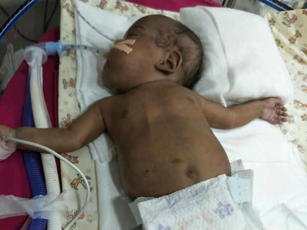 After Losing One Of Their Twins, They’re Struggling To Save The Other After Losing One Of Their Twins, They’re Struggling To Save The Other