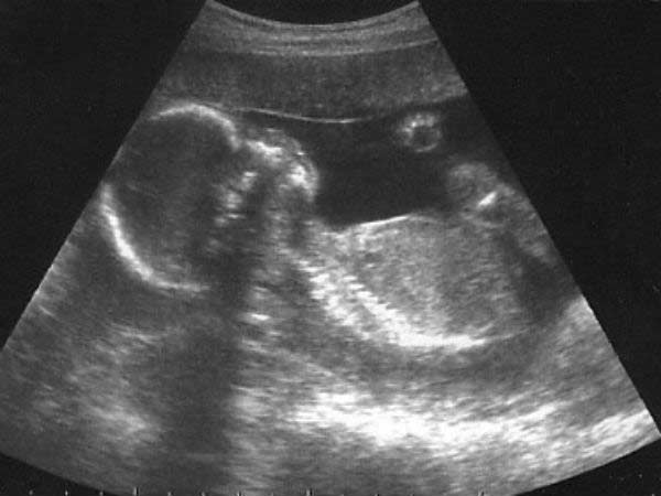 திருவண்ணாமலையில் சட்டவிரோத கருக்கலைப்பு 