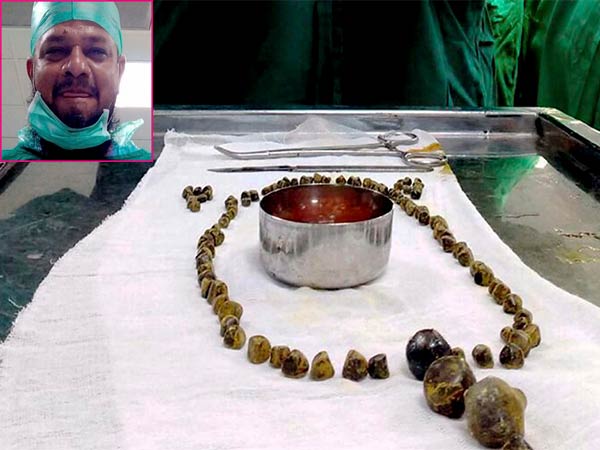 Doctors remove 99 stones from woman’s gallbladder in Karnataka Doctors remove 99 stones from woman’s gallbladder in Karnataka