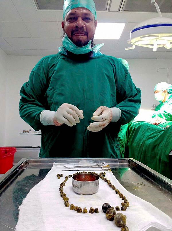 Doctors remove 99 stones from woman’s gallbladder in Karnataka Doctors remove 99 stones from woman’s gallbladder in Karnataka