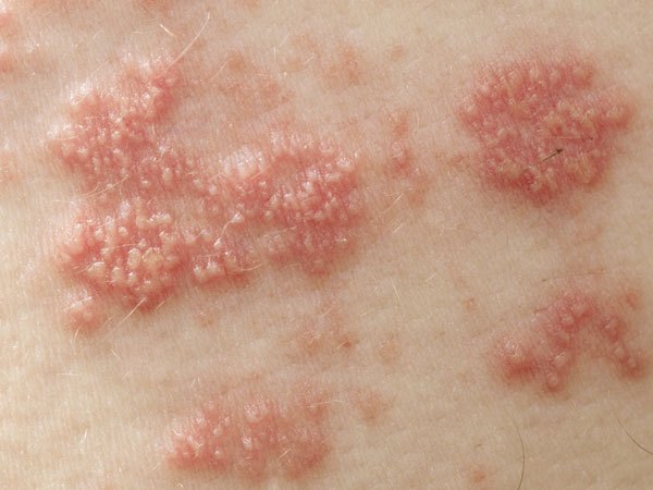 சரும நோய்கள் 