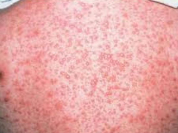 chickenpox viral infected skin disease coming in summer season chickenpox viral infected skin disease coming in summer season