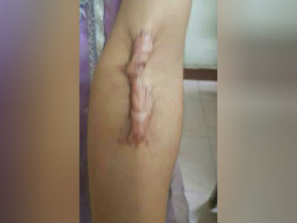 சதை பிய்ந்து கொட்டும் ரத்தம் 