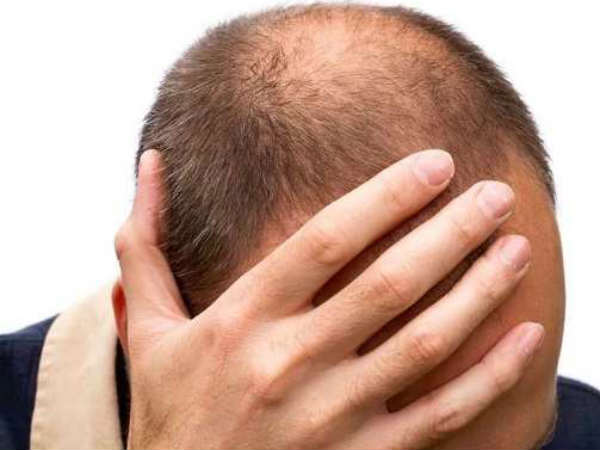 hair loss is a very common condition and affects most people at some time in their lives hair loss is a very common condition and affects most people at some time in their lives