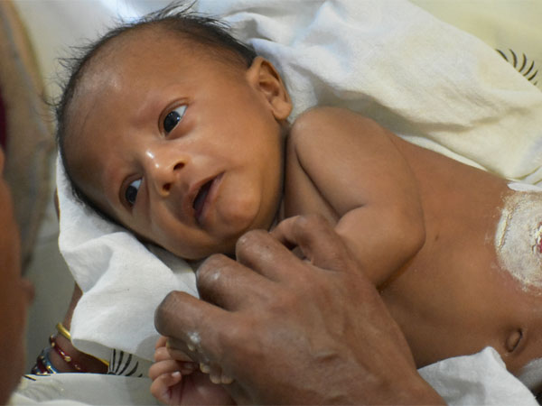 8-Month-Old Anirudh Seeks Your Help For His Final Surgery 