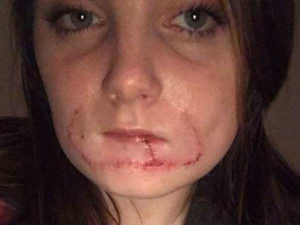 பிஞ்சுபோன உதடு 