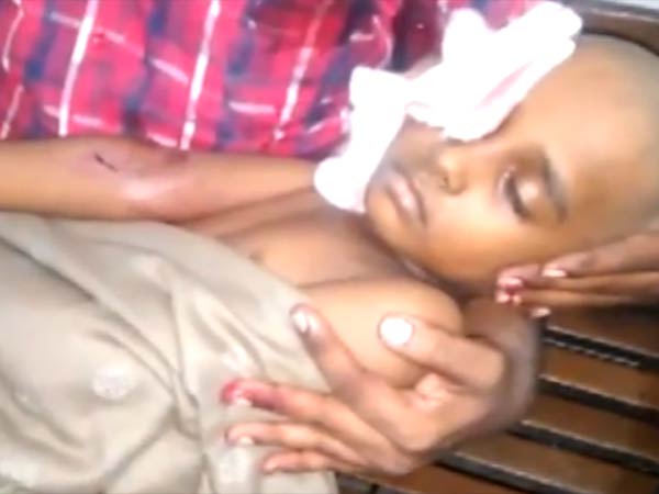  சிறுவனுக்கு தையல்