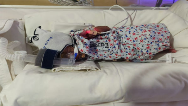 Help for new born premature twin babies for Treatment Help for new born premature twin babies for Treatment