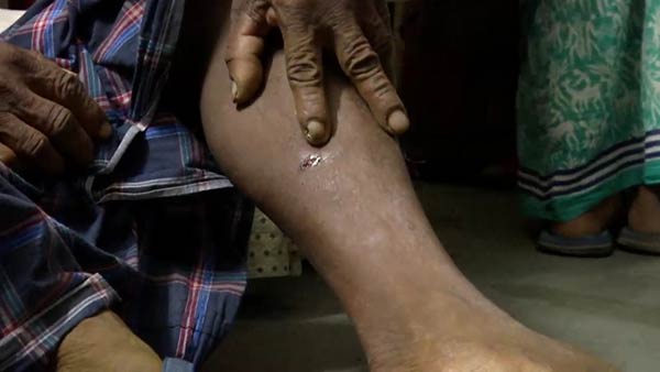 Over 30 people bitten by rabid dog..People panic in Puducherry