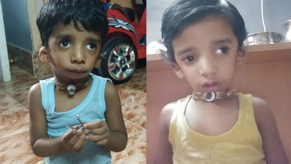 Help 2.5 year old Danish From Treacher Collins Syndrome 