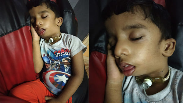 Help 2.5 year old Danish From Treacher Collins Syndrome 