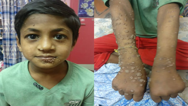 Help 11 year old Kavin From Hyper Ige Syndrom 