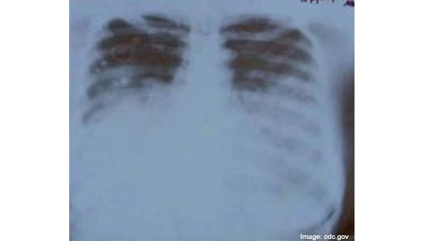 இந்தியாவுக்கு பரவுமா 