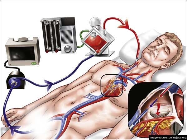 செயற்கை நுரையீரல் செயற்கை நுரையீரல்