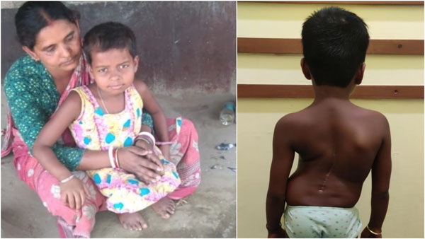 Help 9-year-old Disha recover from congenital scoliosis with tethered cord syndrome Help 9-year-old Disha recover from congenital scoliosis with tethered cord syndrome