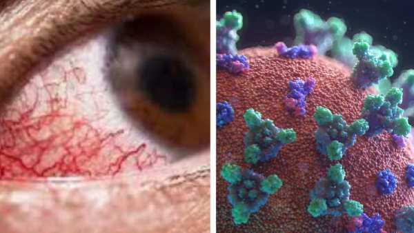 பார்வை பறிபோகக் காரணம் பார்வை பறிபோகக் காரணம்