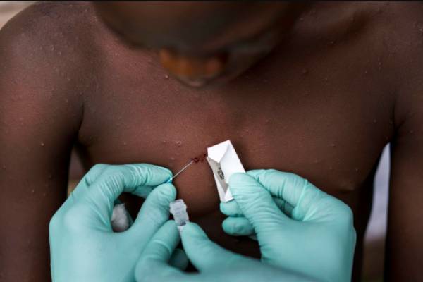 குரங்கு அம்மை