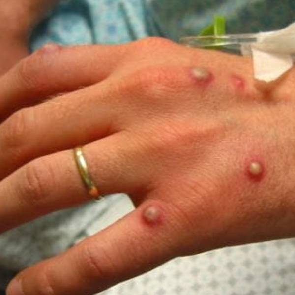 எப்படி பரவும்