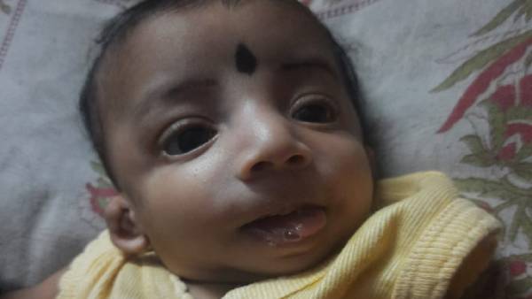 Help 6 month old baby affected with Treacher collins syndrome 