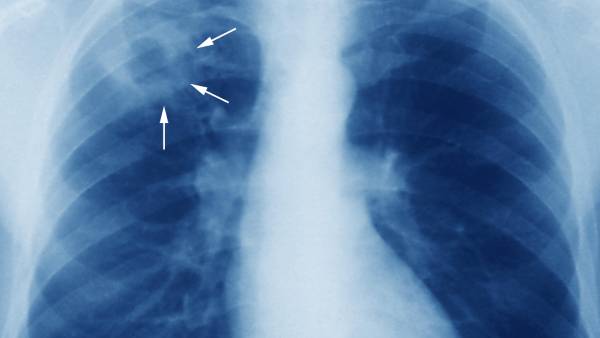 குறைந்தது காசநோய்