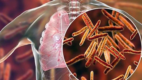 காசநோய் உயிரிழப்புகள்