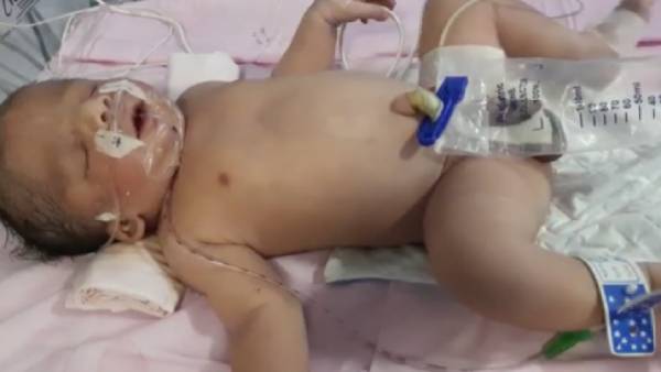 Help 6 month old baby affected with Treacher collins syndrome 