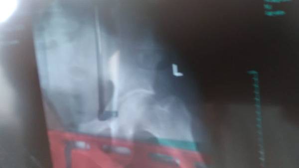 வலது காலில் போடப்பட்ட கட்டு 