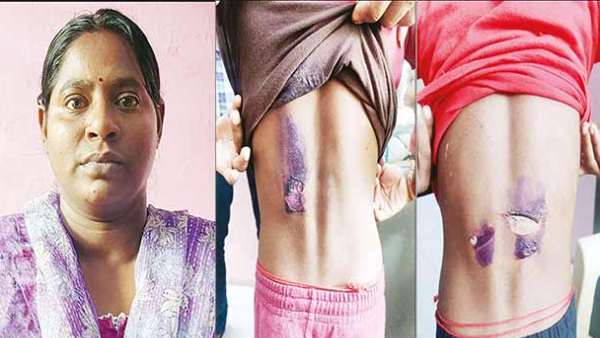 கொப்புளங்கள் கொப்புளங்கள்