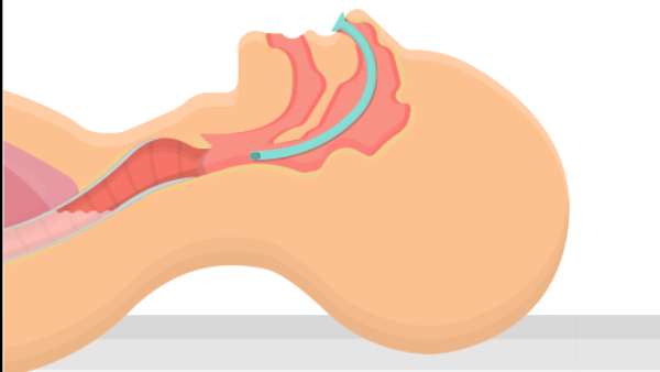  தற்காலிக குரலிழப்பு