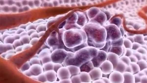 புற்றுநோய் 