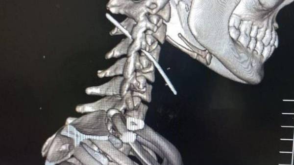 மூச்சுக் குழாய் அருகே ஊசி