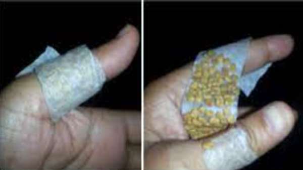  Dr Deepa gives treatment for renal failure patient without dialysis 