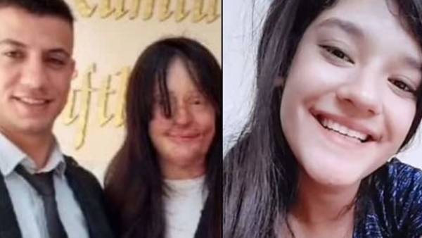 காதலி மீது ஆசிட் வீச்சு