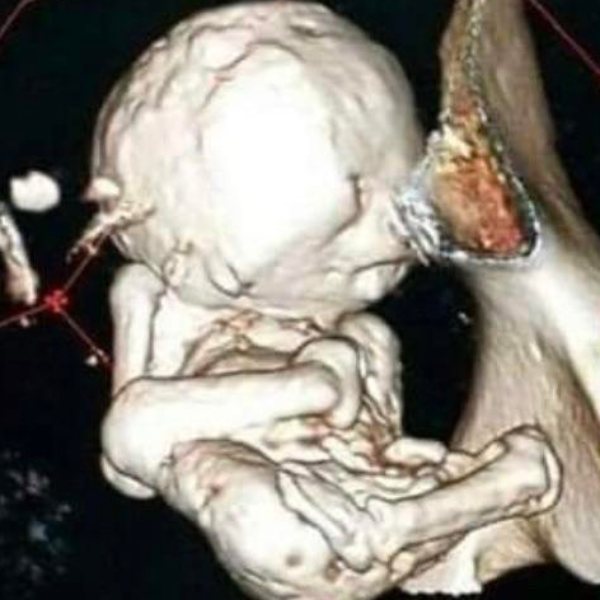 வயிற்றில் கல் குழந்தை வயிற்றில் கல் குழந்தை