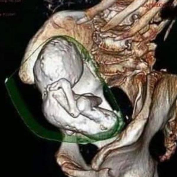 கால்சியம் உப்பு கால்சியம் உப்பு