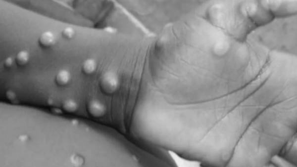  மங்கி பாக்ஸ் 