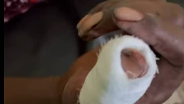  5 தையல்கள் 